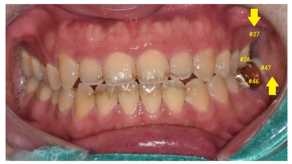 암사동 치과 임플란트 꼭 안 해도 되는 경우 궁금증 해결해 드려요 관련 이미지 8