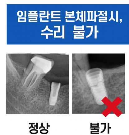 임플란트 사후관리 다른 병원 것도 수리 가능한 경우 정리해드립니다. 관련 이미지 4