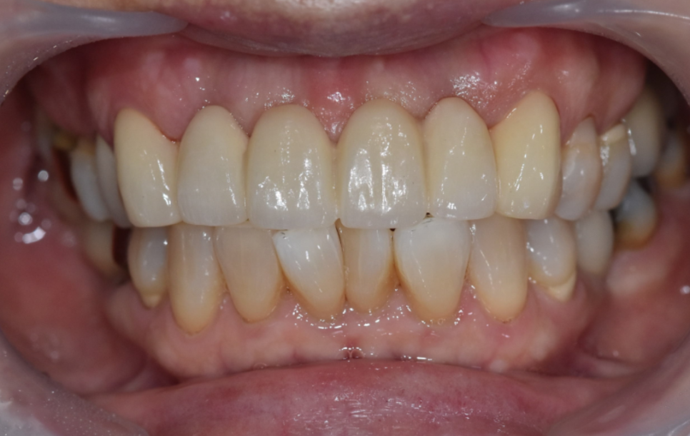 명일동 앞니 브릿지, 새로 교체 할 때 꼭 확인해 봐야 할 관련 이미지 11