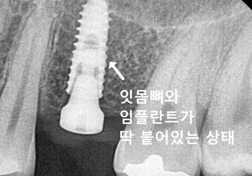 고덕동 치간 이개, 위 앞니 벌어짐, 교정? 라미네이트? 고민이시라면 필독 관련 이미지 5