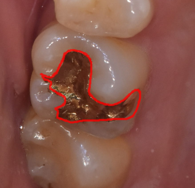 치아 땜질 다 떼울 수는 없지만..강동구 치과에서는 이렇게 합니다. 관련 이미지 6
