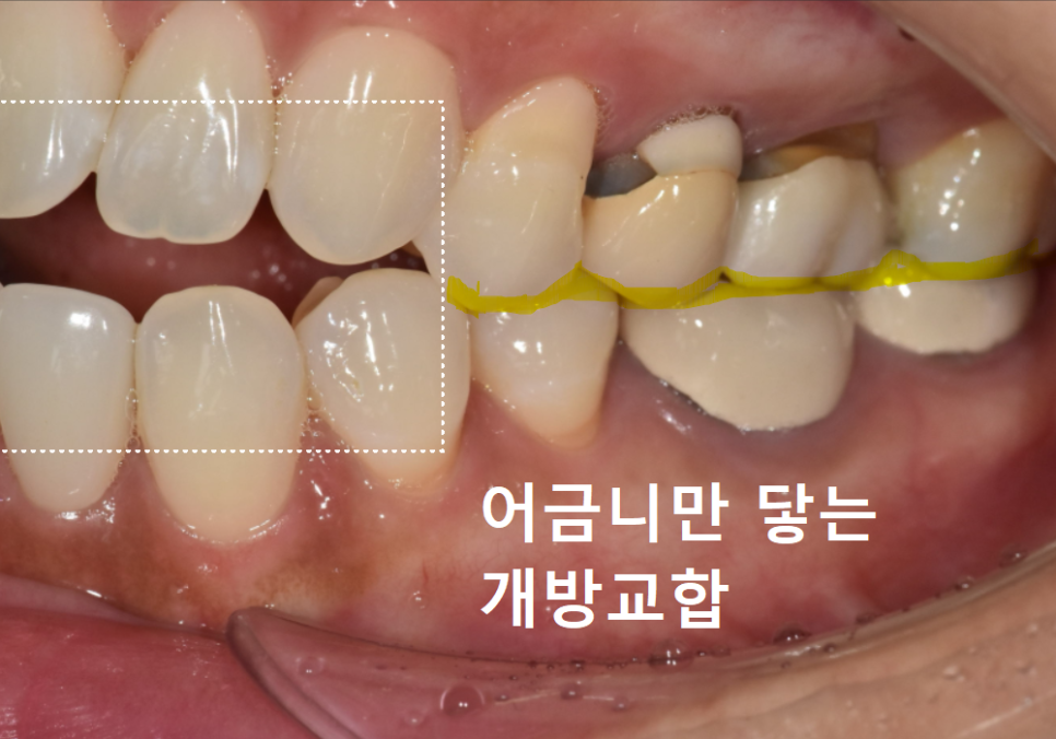 앞니 라미네이트 교체, 재시술 전 꼭 알아야 할 실패를 줄이는 방법 관련 이미지 6