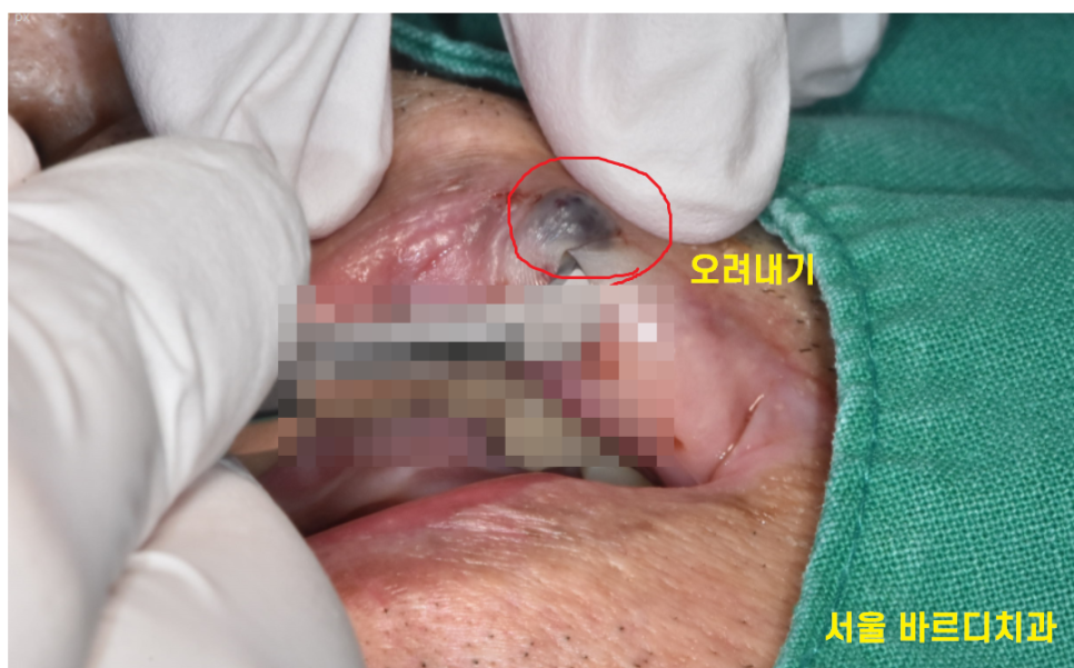 입술 혹 씹었을때 부풀고 딱딱 하다면 간단히 제거하세요 관련 이미지 4