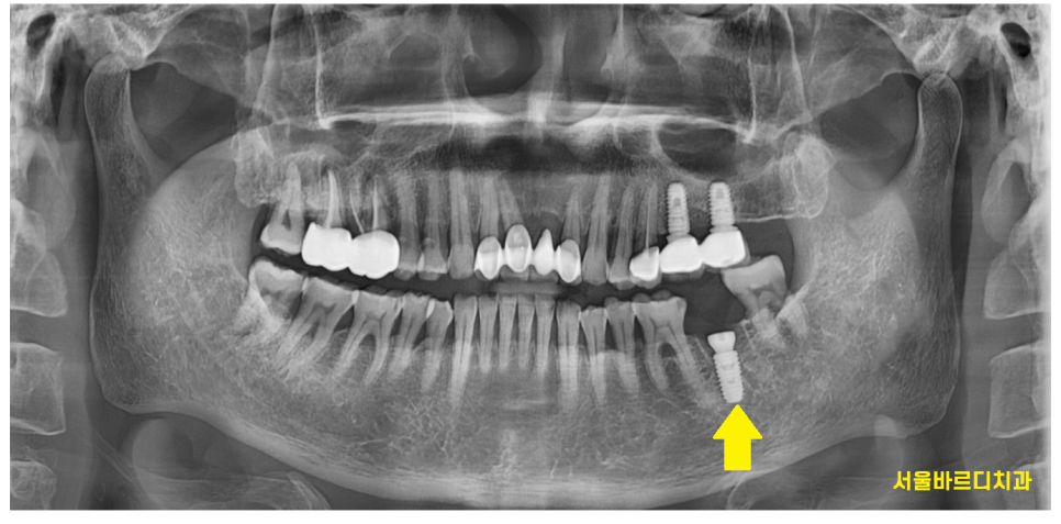 천호동 치과 충치로 인하여 손상된 치아 임플란트로 대처하기 관련 이미지 5