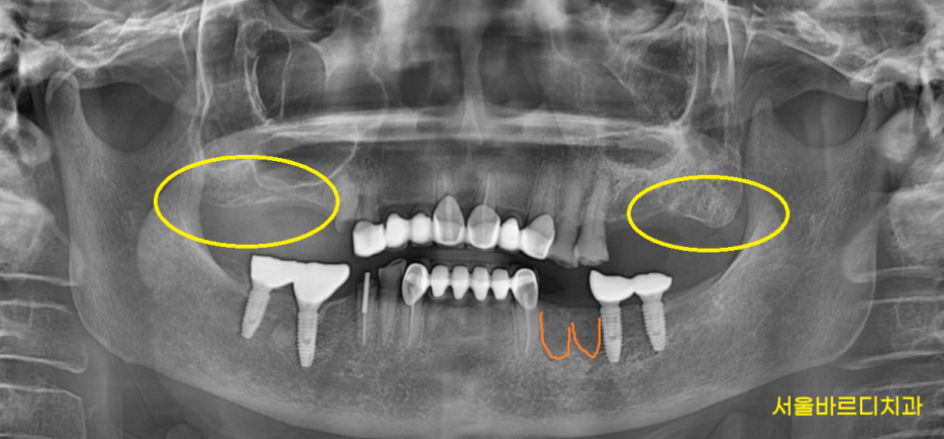 추석 효도선물로 임플란트 하세요 치아 없으면 최소 10년은 손해봅니다. 관련 이미지 6