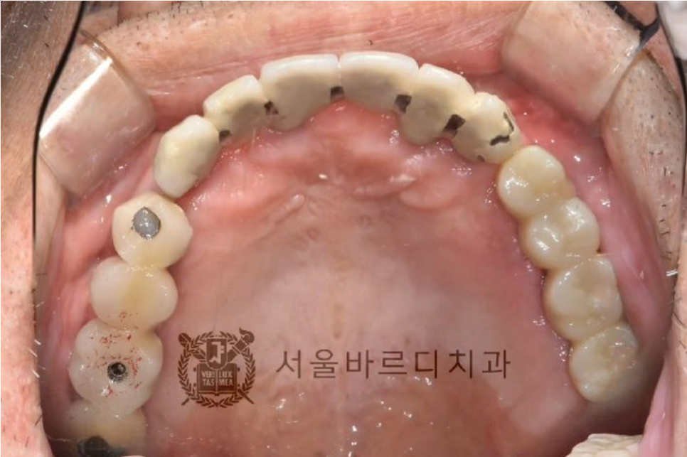 상일동역치과 서울바르디치과 무절개 네비게이션 임플란트 치료증례 #5 관련 이미지 19