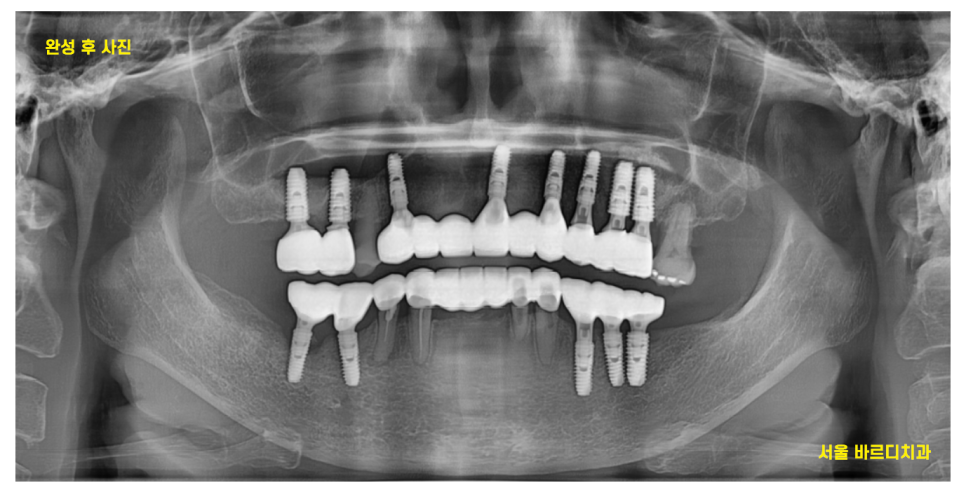 암사동 치과 전악 임플란트 하루만에 끝냈습니다. 관련 이미지 11