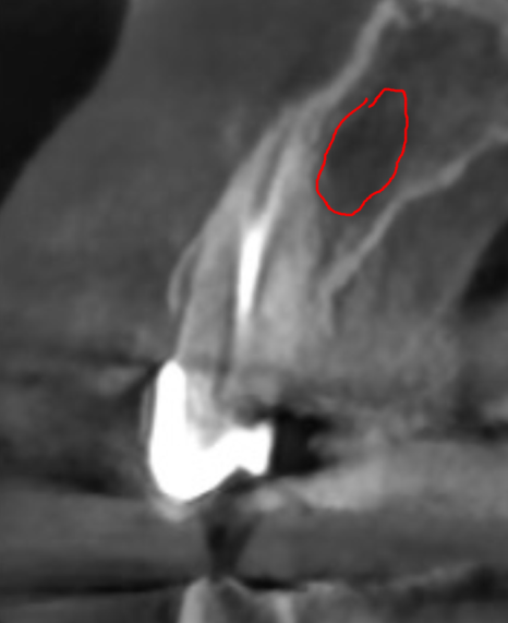 앞니 고름, 잇몸약을 먹어도 왜 염증이 가라앉지 않을까요? 관련 이미지 9
