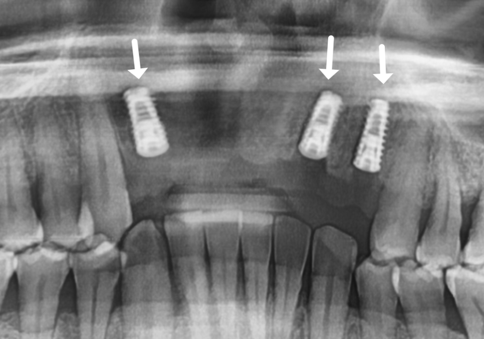 앞니 브릿지 부러짐, 이런 상태라면 절대 브릿지 다시 하지 마세요. 관련 이미지 12
