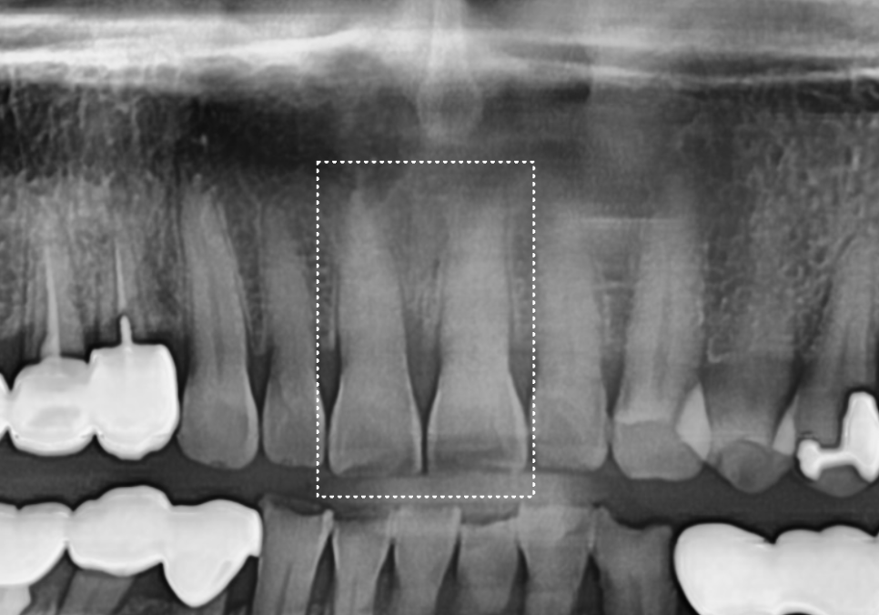마모된 윗 앞니가 까맣게 변했다면? 방치하면 안 되는 이유 관련 이미지 3