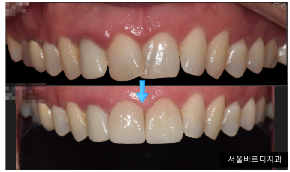 누런니 라미네이트와 미백중 뭐가 더 좋을까요?? 암사동 치과 관련 이미지 5