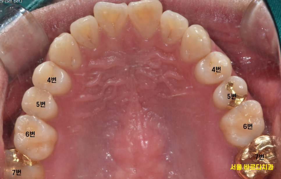 고덕역 치과 빠진 어금니 방치 그대로 두다가는 임플란트가..? 관련 이미지 2