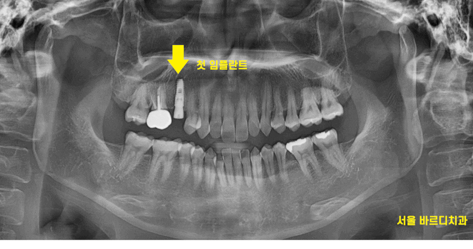 강동구 임플란트 치과 뿌리만 남은 치아 시작이 좋아야 끝도 좋으니까!! 관련 이미지 1