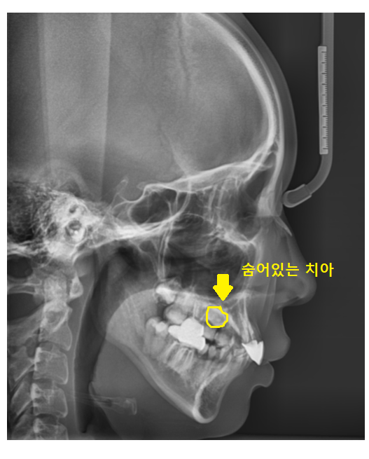 덕풍동 치과 교정 치료 위해 숨어있는 매복치 수술 발치 문제없습니다 관련 이미지 4
