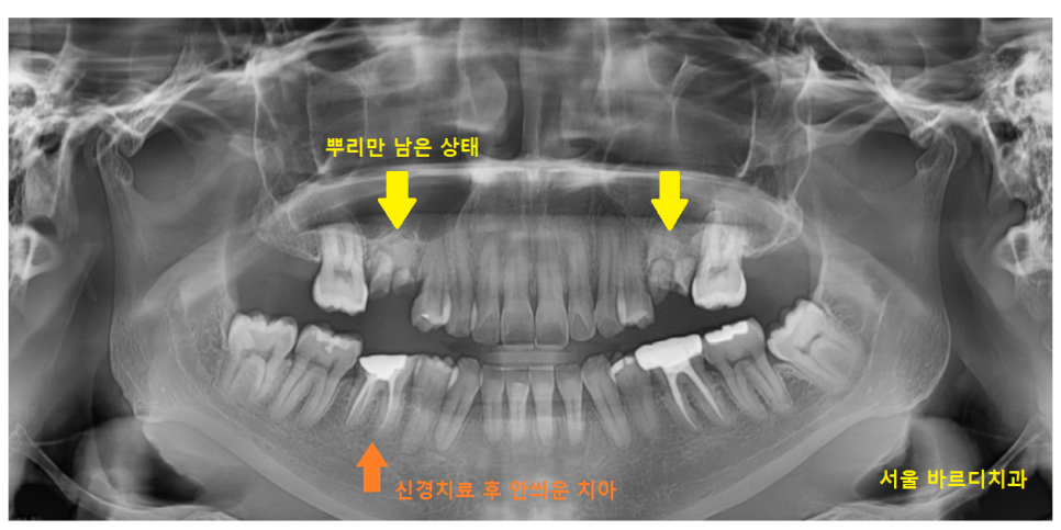 풍산동 치과 임플란트 양쪽 치료 가능한가요? 관련 이미지 2