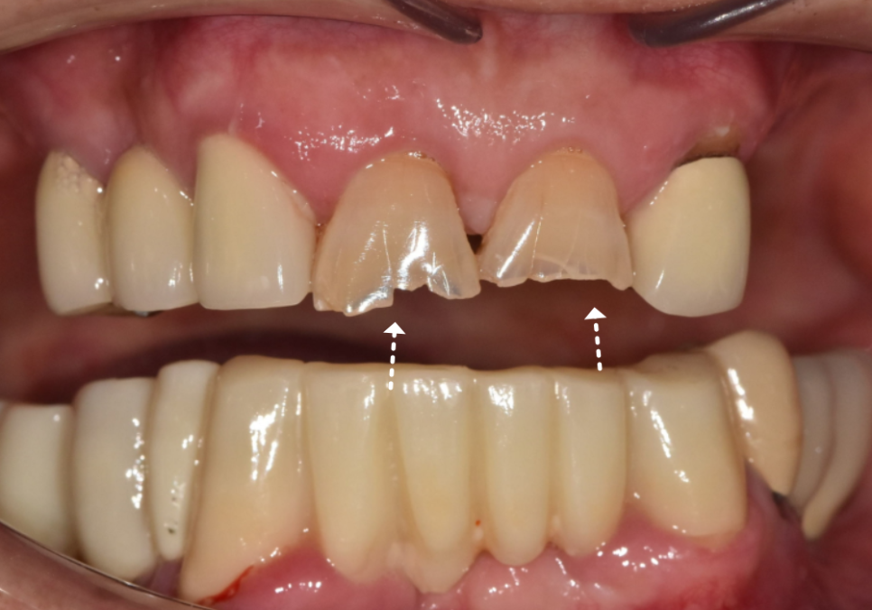 대문니 파절, 앞니에 금이 쩍 갈라졌다면? 딱딱한 음식을 조심해야 하는 이유 관련 이미지 3