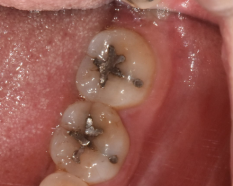 치아 땜질 다 떼울 수는 없지만..강동구 치과에서는 이렇게 합니다. 관련 이미지 2