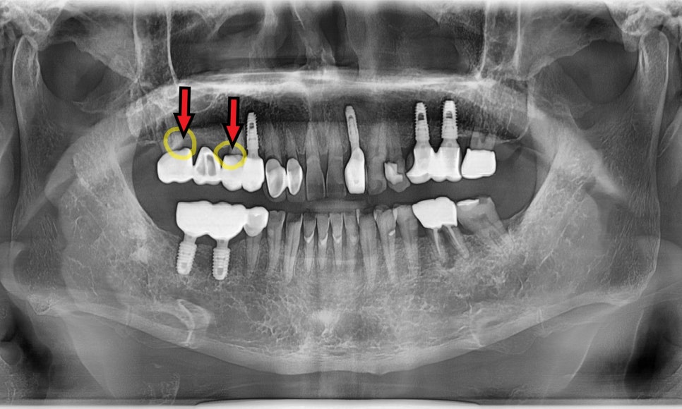 강동구 치아 뿌리 염증, 신경치료 한 치아인데도 아플 수 있나요? 관련 이미지 3