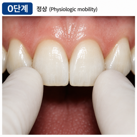 상일동역치과 흔들리는 치아 무조건 뽑아야 할까요? 관련 이미지 2