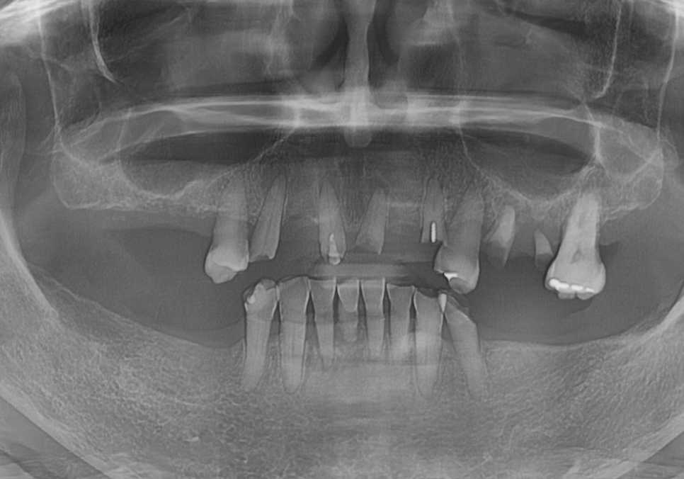 뿌리만 남은 치아, 그대로 두면 왜 위험할까요? 고덕동 전체 임플란트 재건 사례 관련 이미지 16