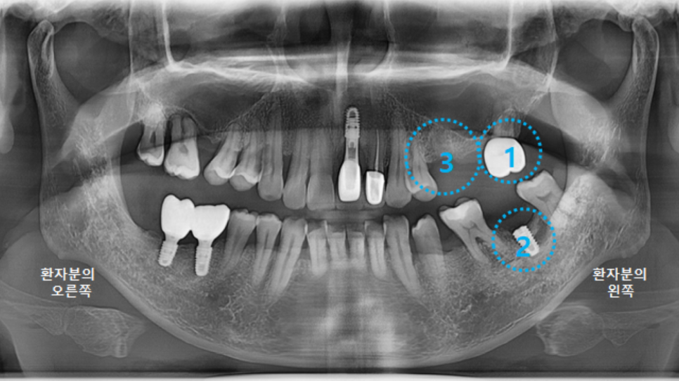 고덕동치과 서울바르디치과 전치부 및 구치부 임플란트 치료증례 #9 관련 이미지 17