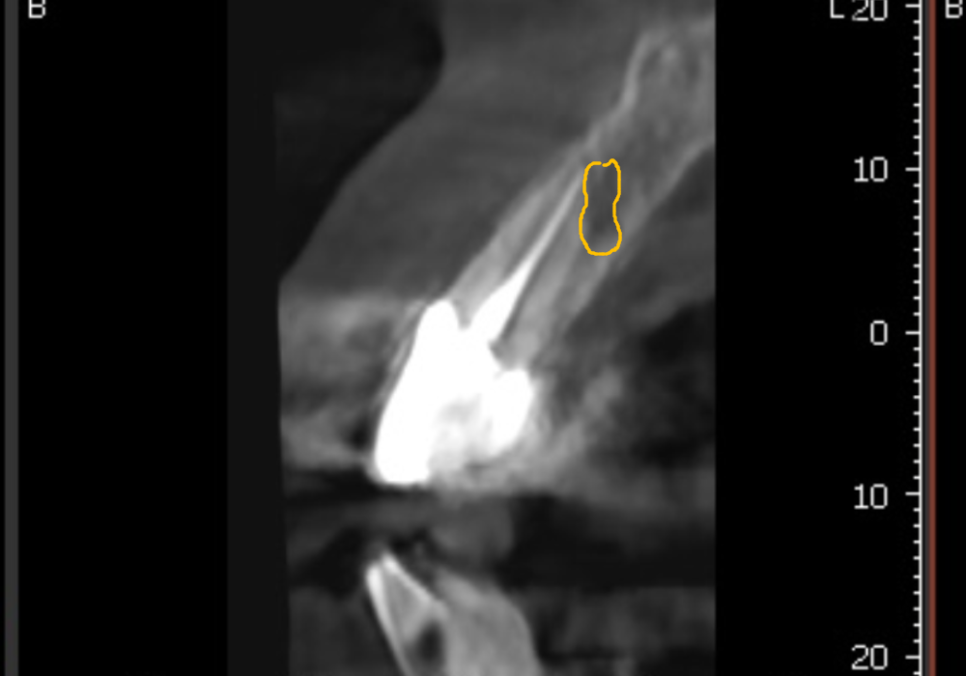 오래된 앞니 크라운 냄새, 관련 이미지 7