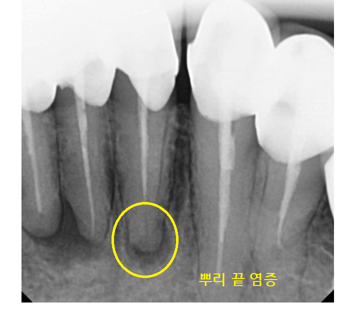 명일동 치과 뿌리 염증으로 입냄새가 나요 해결책은? 관련 이미지 10