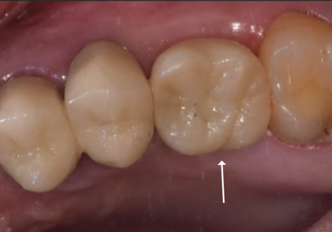 어금니 구멍, 충치 솔직하게 말씀드립니다. 치과 공포증으로 미루신 분들 필독 관련 이미지 15