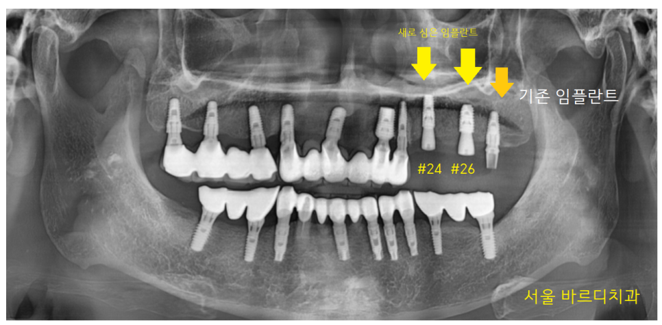 덕풍동 치과 오래된 임플란트 제거 후 재식립하였습니다. 관련 이미지 11