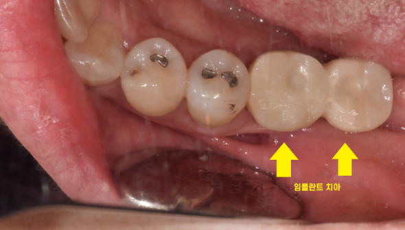 상일동역 치과에서 알려드리는 임플란트 수술과정 대공개 관련 이미지 12