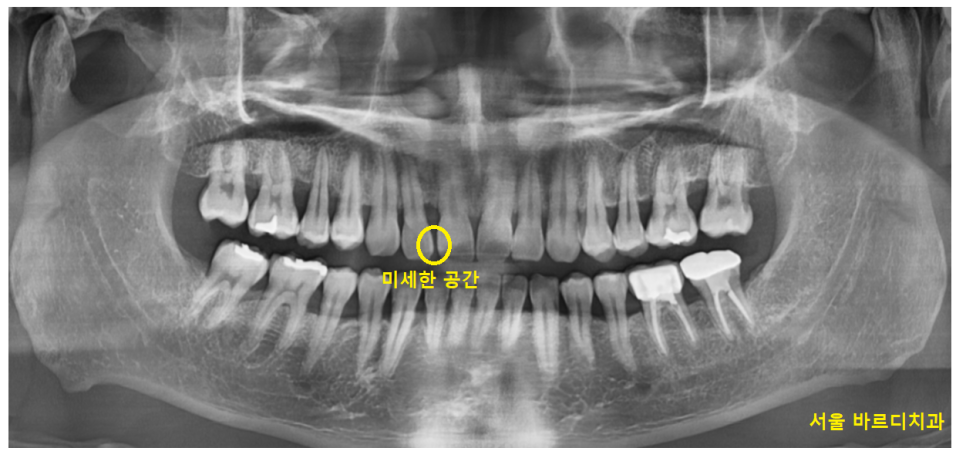 고덕 그라시움 치과 벌어진 앞니 메꾸기 당일 레진으로 치료했습니다. 관련 이미지 1