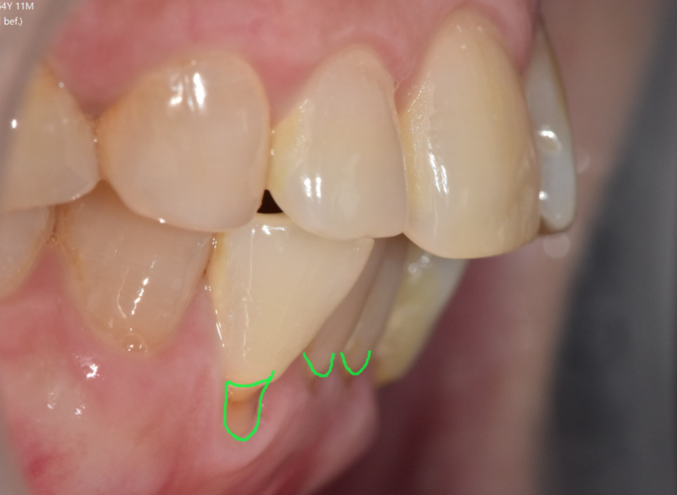 The Moment You Decide on Orthodontic Treatment in Your 50s Is the Fastest image 3