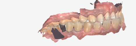 어금니 구멍, 충치 솔직하게 말씀드립니다. 치과 공포증으로 미루신 분들 필독 관련 이미지 13