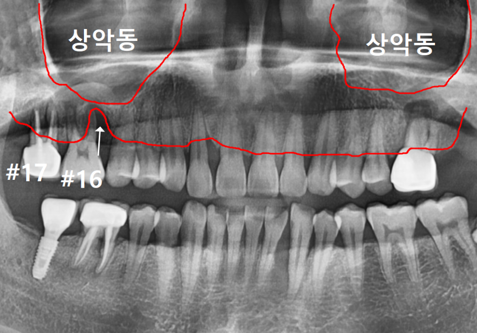 상악동 거상술 부작용 걱정되시나요? 재수술 없는 뼈이식의 정석 공개 관련 이미지 6