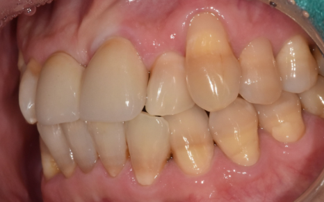 잇몸 내려감으로 길어진 치아, 방치하면 안 되는 원인, 증상, 이유 관련 이미지 14