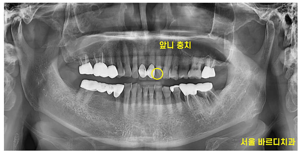 미사역 치과 앞니 충치 레진으로 당일 수복 완료하였습니다. 관련 이미지 2