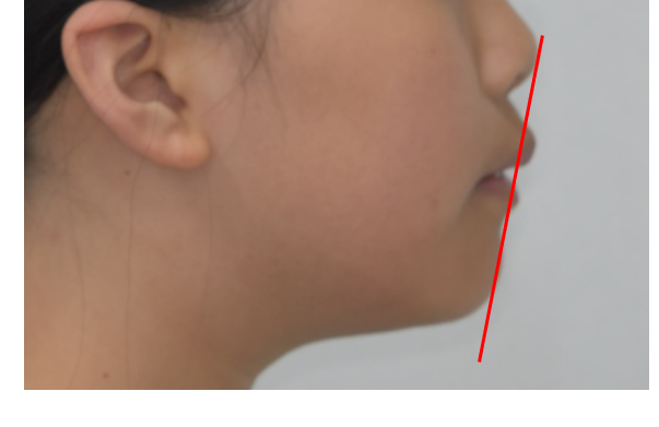 고덕 소아교정 아이 성장기를 이용한 단 한 번의 기회! 관련 이미지 5