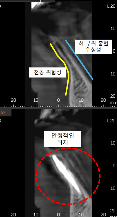 고덕동치과 서울바르디치과 전치부 및 구치부 임플란트 치료증례 #10 관련 이미지 7