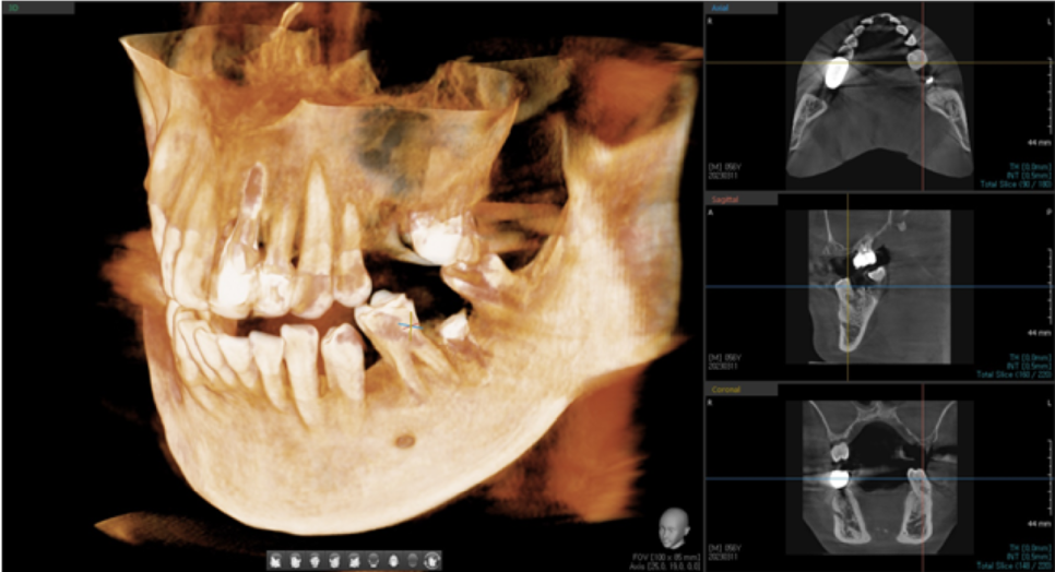 고덕동치과 서울바르디치과 전치부 및 구치부 임플란트 치료증례 #9 관련 이미지 22