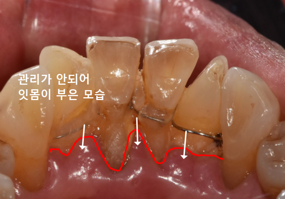 흔들리는 치아 묶어두는 잠간고정술, 오히려 잇몸뼈를 녹일 수도 있다고요? 관련 이미지 5