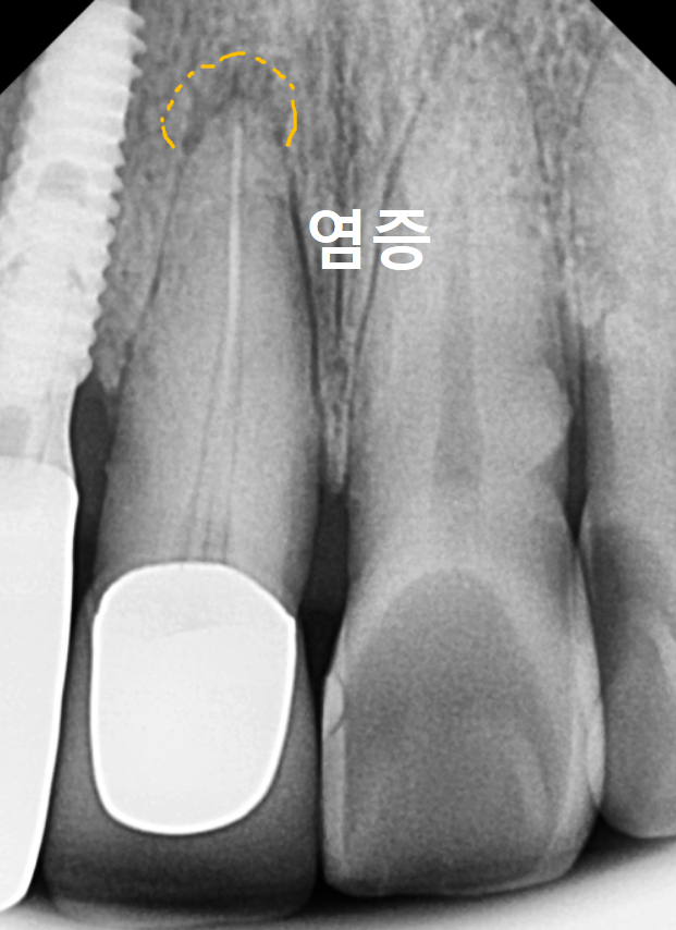 앞니 임플란트, 원내 기공소의 중요성을 아시나요? 관련 이미지 12