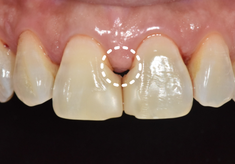 고덕동 치과 누런 이, 앞니 사이 틈, 잘못된 관리 때문일까? 관련 이미지 7