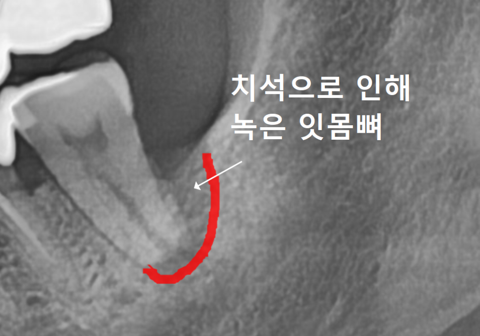 흔들리는 치아 묶어두는 잠간고정술, 오히려 잇몸뼈를 녹일 수도 있다고요? 관련 이미지 3
