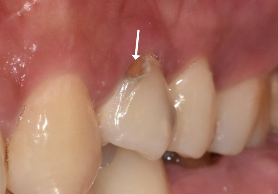 A Single Black Spot of Decay Between the Front Teeth May Be a Warning Sign of Multiple Cavities. image 2