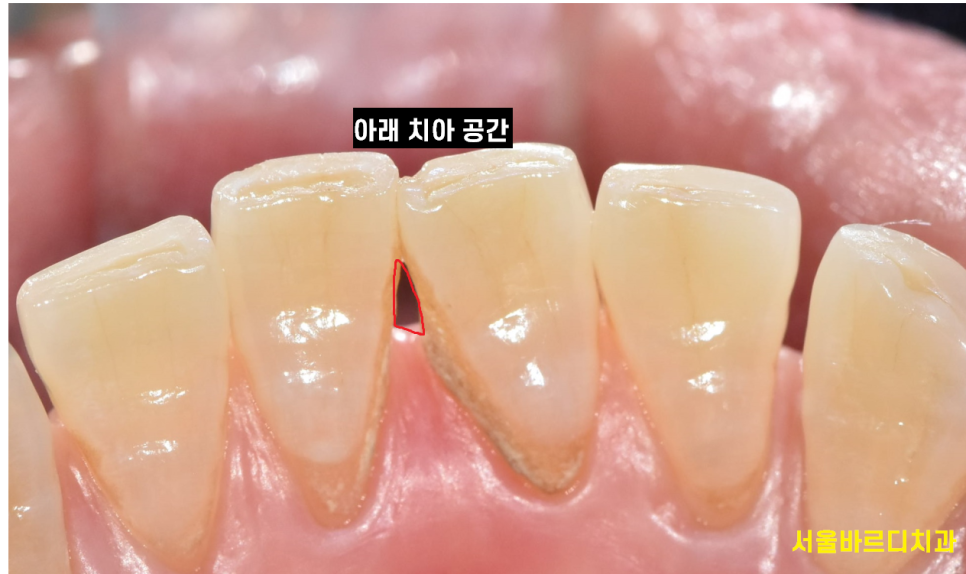 앞니 치아 사이 벌어짐 라미네이트로 컴플렉스 극복! 관련 이미지 3