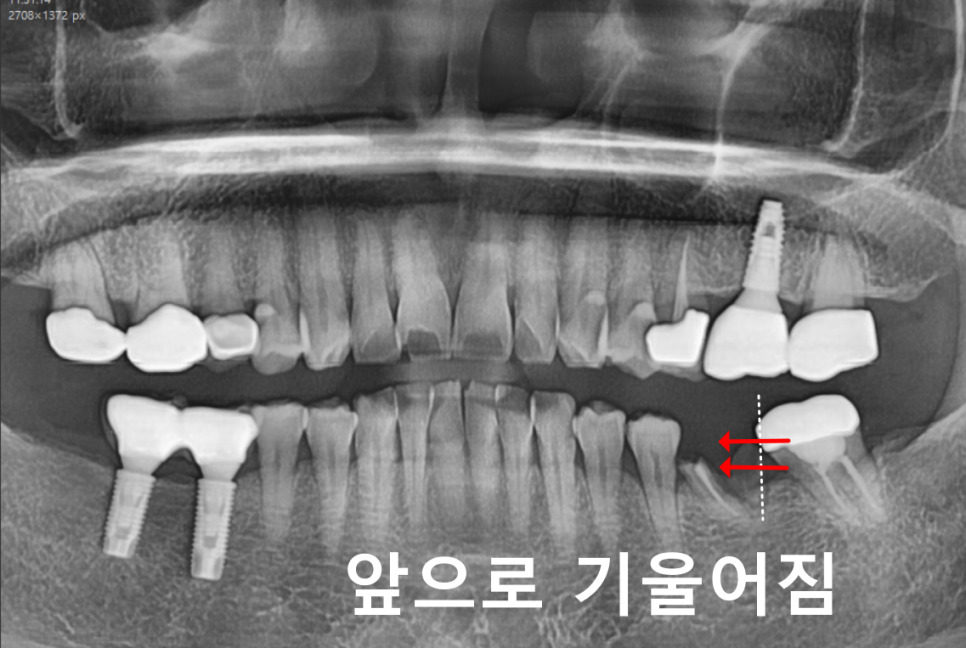 고덕동 20대 임플란트, 시기 놓치면 비용 2배 이상 듭니다. 관련 이미지 2
