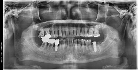 Implant Treatment for a Fractured Molar Split in Half After Neglect Following Root Canal Treatment image 5