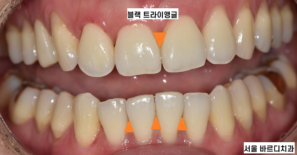 상일동역 치아교정 부작용 꼭 알아보고 대처하세요!!! 관련 이미지 3