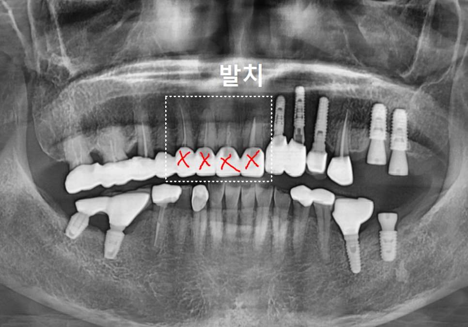 앞니 브릿지 탈락, 씌워둔 게 빠졌어요. 다시 붙일 수 있을까요? 관련 이미지 11