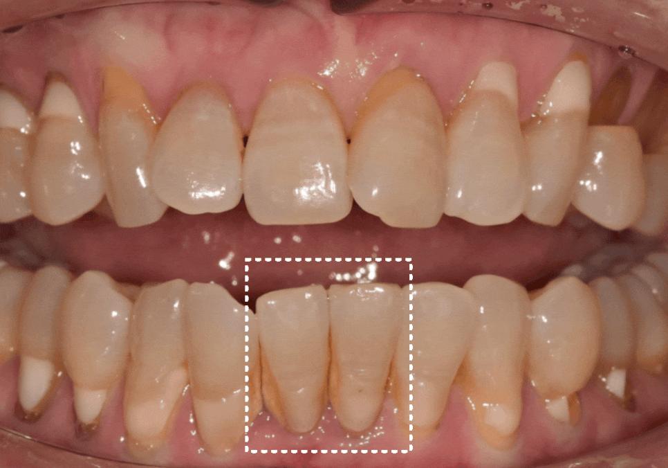 고덕동 아래 앞니 임플란트 비용 줄이는 비법, 공개합니다. 관련 이미지 14